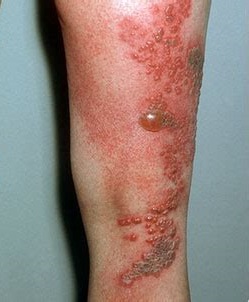 foto herpes en la pierna